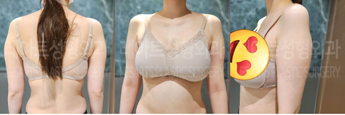 post_76_02_arm_liposuction_04