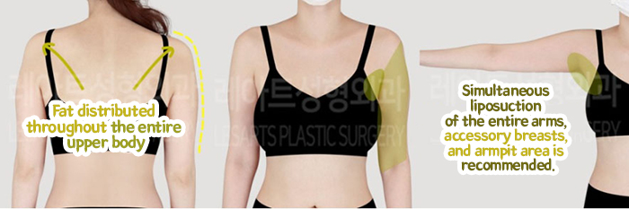 post_76_02_arm_liposuction_05