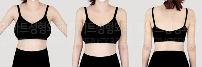 post_76_02_arm_liposuction_06
