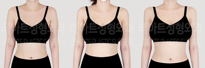 post_76_02_arm_liposuction_07