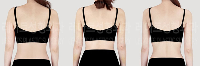 post_76_02_arm_liposuction_09