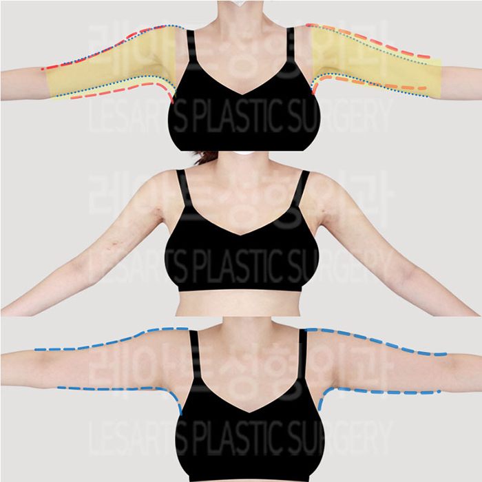 post_76_02_arm_liposuction_10