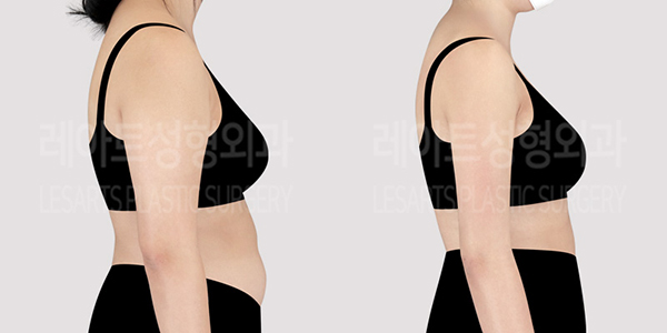 post_77_01_arm_liposuction_thumbnail