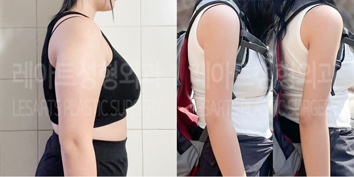 post_77_02_arm_liposuction_01