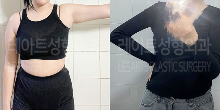 post_77_02_arm_liposuction_02