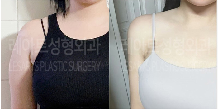 post_77_02_arm_liposuction_03