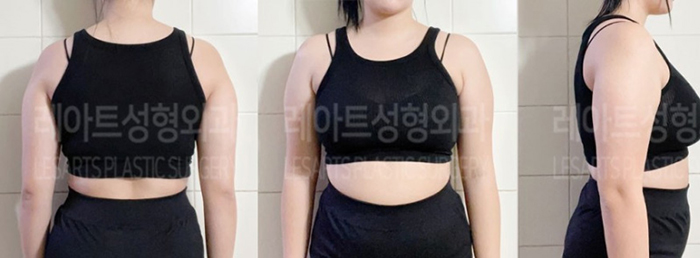 post_77_02_arm_liposuction_04