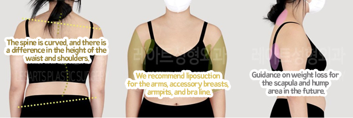 post_77_02_arm_liposuction_05