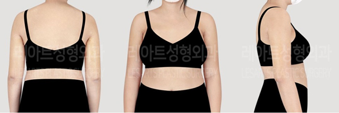post_77_02_arm_liposuction_06