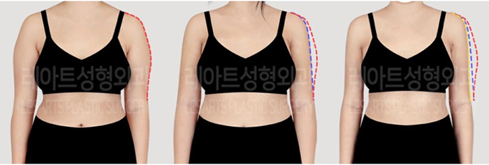 post_77_02_arm_liposuction_07