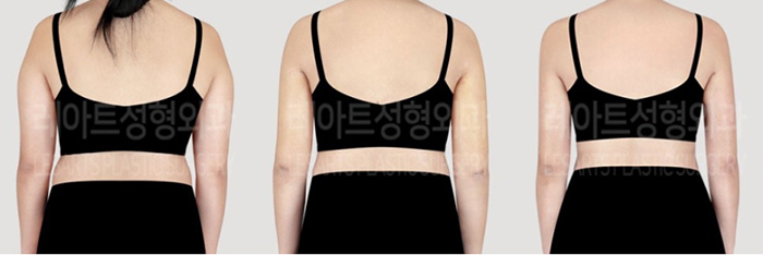 post_77_02_arm_liposuction_08