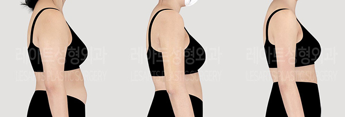 post_77_02_arm_liposuction_09