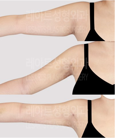 post_77_02_arm_liposuction_10