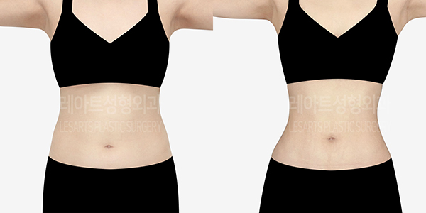 post_78_01_abdominal_liposuction_thumbnail