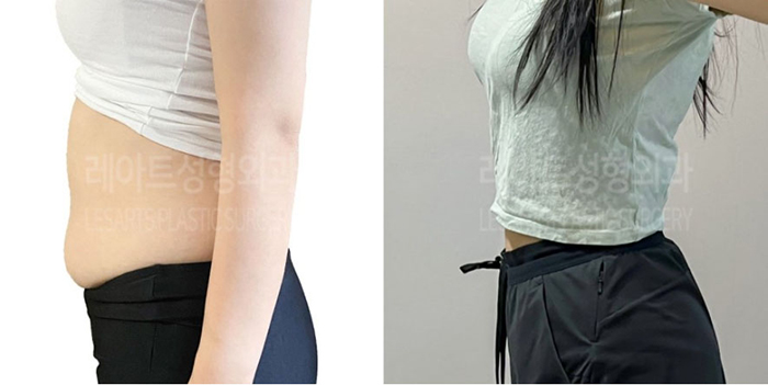 post_78_02_abdominal_liposuction_01