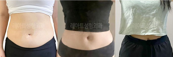 post_78_02_abdominal_liposuction_02