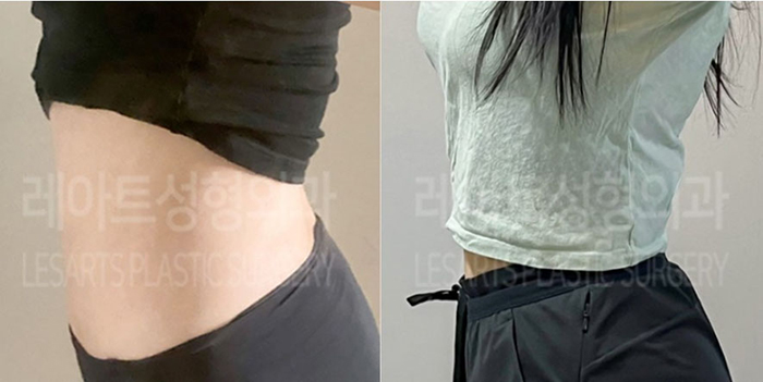 post_78_02_abdominal_liposuction_03