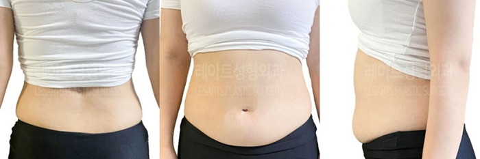 post_78_02_abdominal_liposuction_04