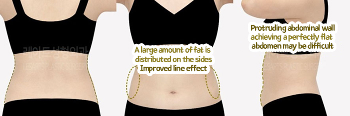 post_78_02_abdominal_liposuction_05