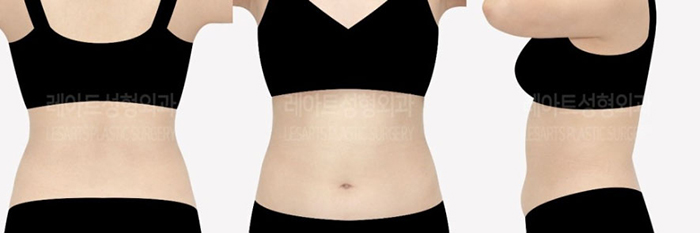 post_78_02_abdominal_liposuction_06