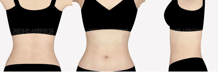 post_78_02_abdominal_liposuction_07