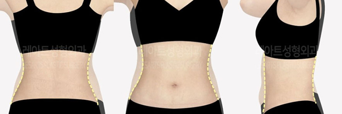 post_78_02_abdominal_liposuction_08