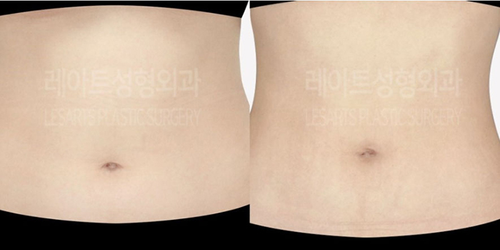 post_78_02_abdominal_liposuction_09