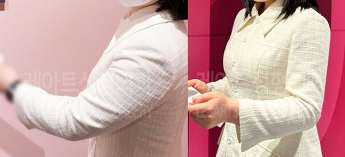 post_79_02_arm_liposuction_01