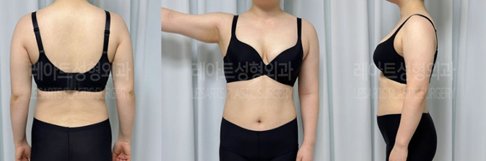 post_79_02_arm_liposuction_05