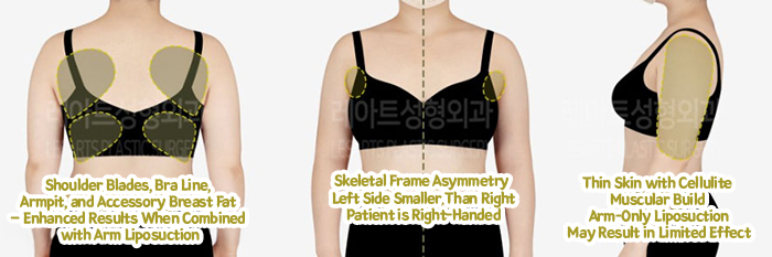 post_79_02_arm_liposuction_06