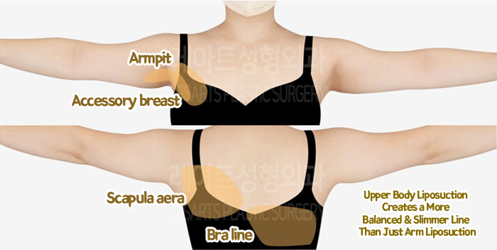 post_79_02_arm_liposuction_07