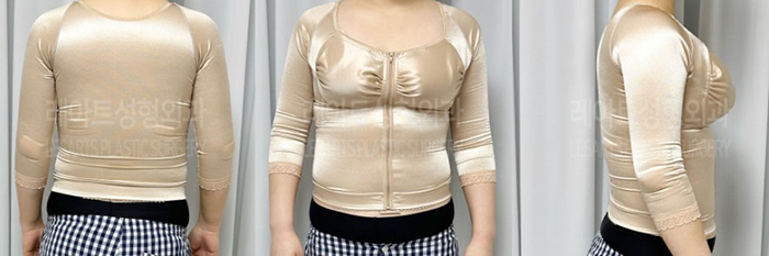 post_79_02_arm_liposuction_08