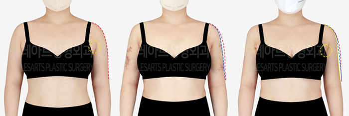 post_79_02_arm_liposuction_09