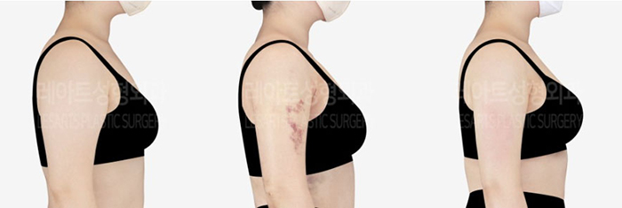 post_79_02_arm_liposuction_11