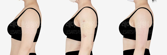 post_79_02_arm_liposuction_12