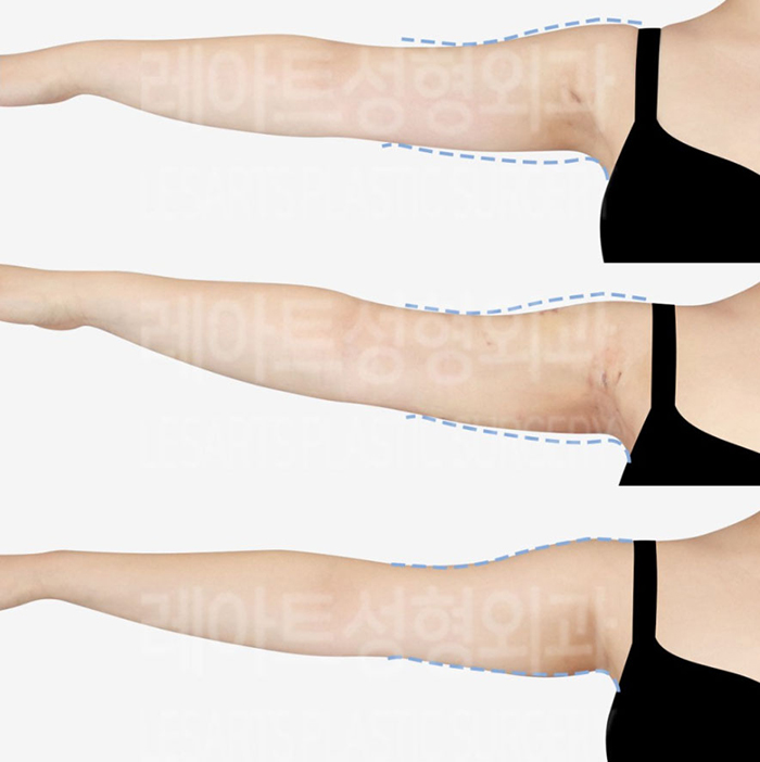 post_79_02_arm_liposuction_13