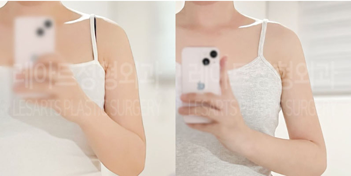 post_80_02_arm_liposuction_01