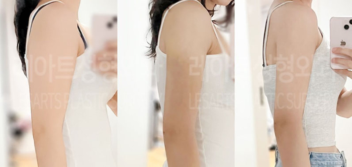 post_80_02_arm_liposuction_02