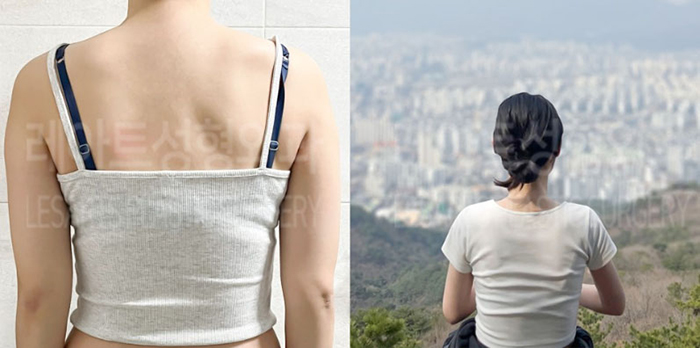 post_80_02_arm_liposuction_03