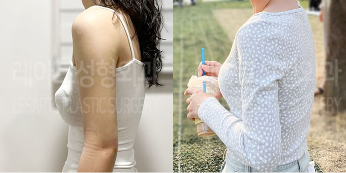 post_80_02_arm_liposuction_04