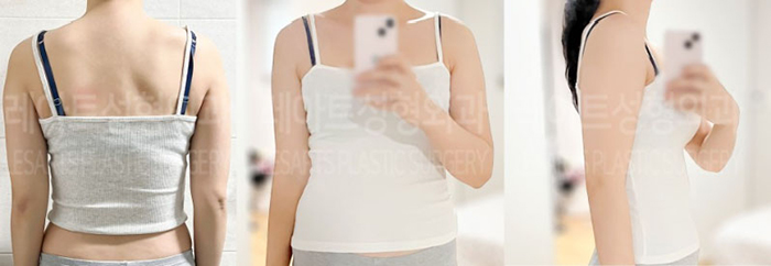 post_80_02_arm_liposuction_05