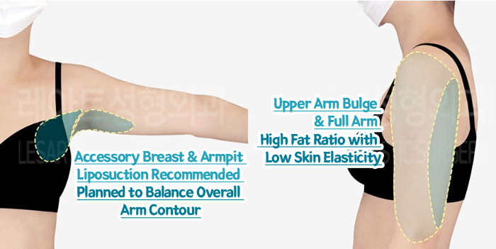 post_80_02_arm_liposuction_06
