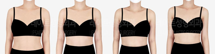 post_80_02_arm_liposuction_07
