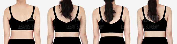 post_80_02_arm_liposuction_08