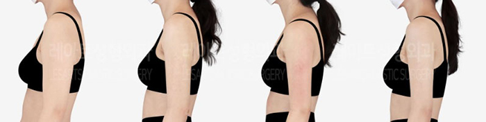 post_80_02_arm_liposuction_09