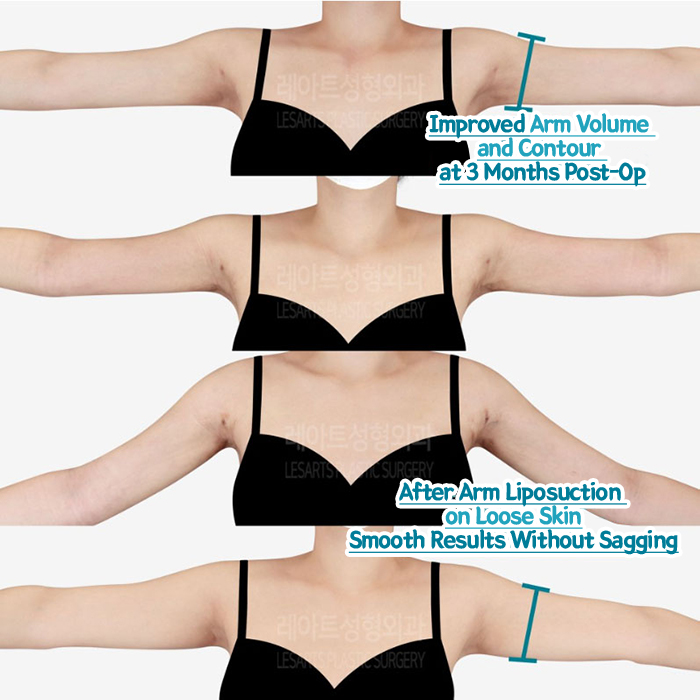post_80_02_arm_liposuction_10