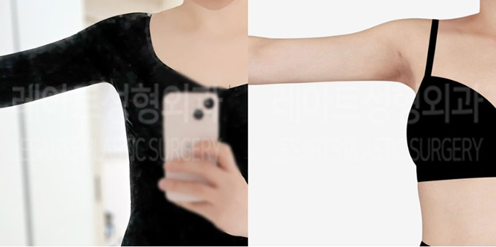 post_80_02_arm_liposuction_11