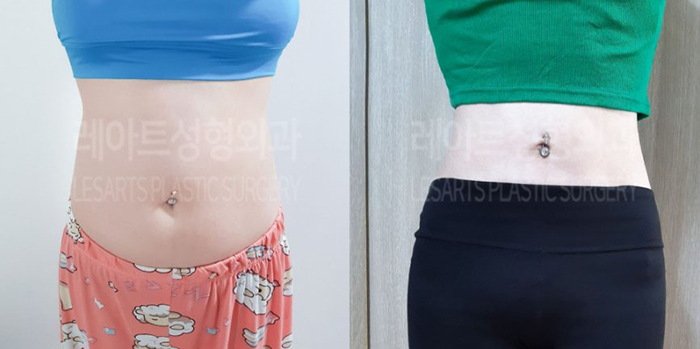 post_81_02_abdominal_liposuction_01