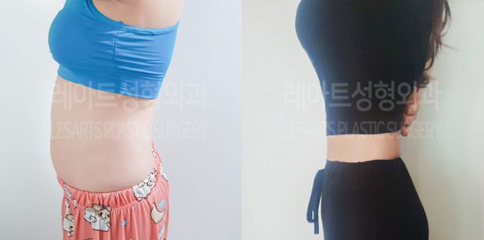 post_81_02_abdominal_liposuction_02