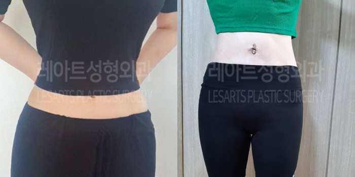 post_81_02_abdominal_liposuction_03